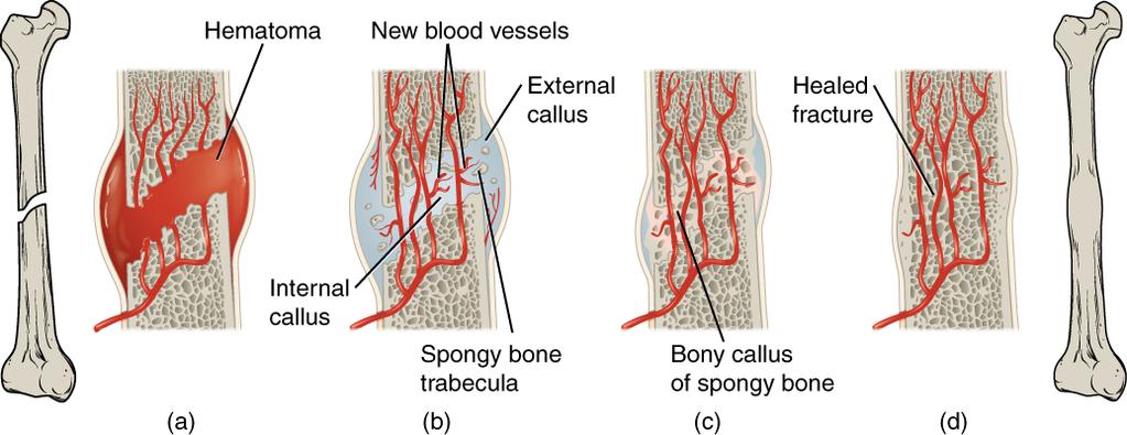 Bone fractures are repaired in steps 1. Formation of fracture hematoma: Bleeding from damaged blood vessels, clots 2.