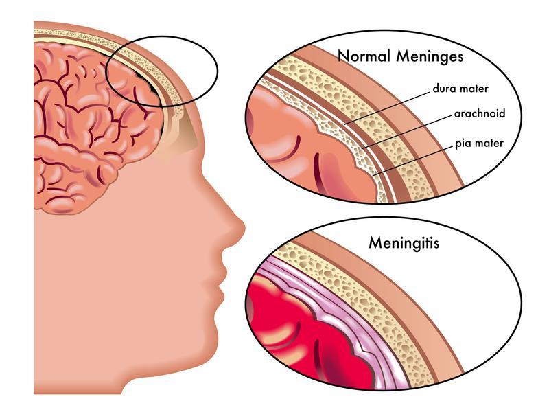 1. Aseptic meningitis This is the commonest viral syndrome. The condition is self-limiting and has a good prognosis. Infection is confined to the meninges.