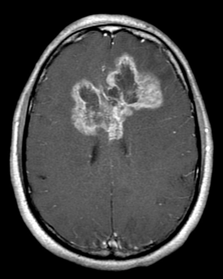Glioblastoma (GBM) Most common malignant primary brain tumor: 45.2% of all malignant CNS tumors and 80% of all primary malignant CNS tumors Incidence of 3.