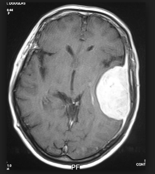 Meningioma Derived from arachnoid cells Most common (36%) of all brain tumors, female bias Dural