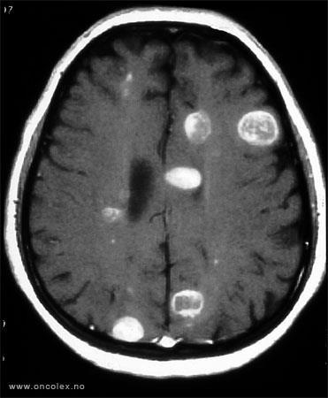 Brain Metastases Prognoses vary based on primary histology, commonly Breast or Lung Could also be melanoma, lymphoma, GI and others Management: Steroids