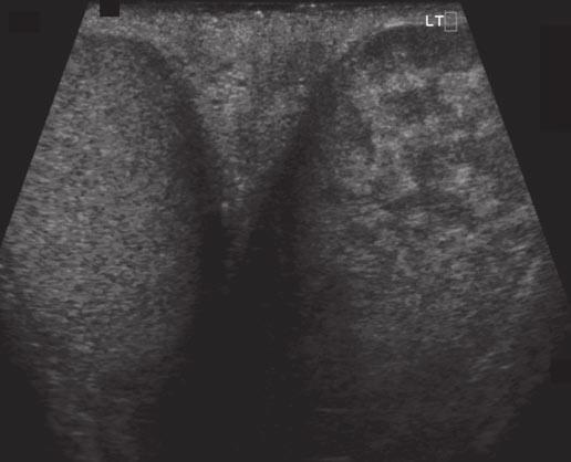 Stengel and Remer Fig. 1 17-year-old boy with acute scrotal pain. A, Gray-scale transverse sonogram scrotum shows markedly heterogeneous echotexture of left testis.