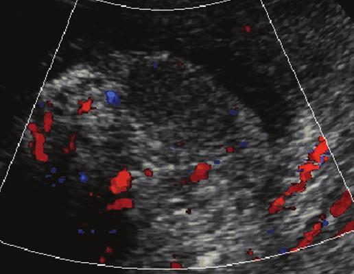 Color Doppler sonogram shows focal rounded hypoechoic avascular lesion in superior pole of left testis. Segmental infarction is diagnosis at orchiectomy.