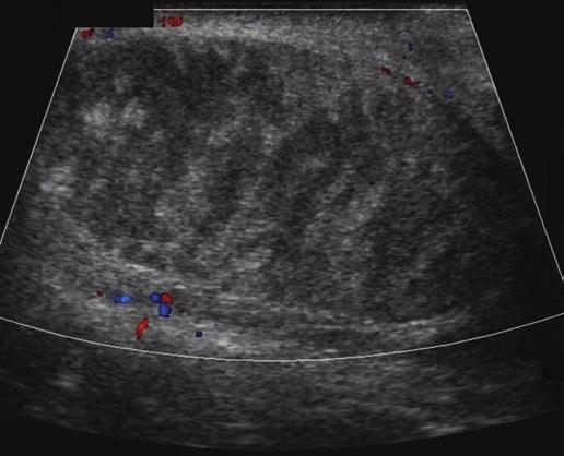 The absence of flow in the affected testis shown on color and spectral Doppler sonography is a highly sensitive and specific finding in acute testicular torsion. Option B is the best response.