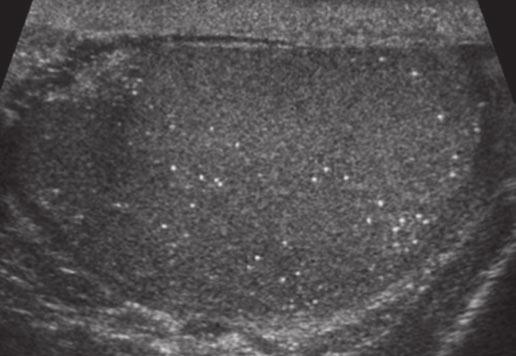 Sonography of the Scrotum: Review QUESTION 7 Which of the following is NOT a current management recommendation for patients with testicular microlithiasis? A. Physical examination at least annually.