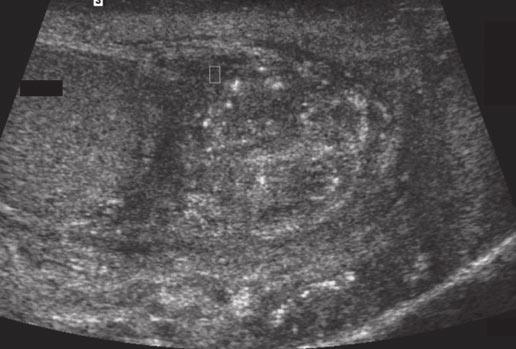 Sonography of the Scrotum: Review Fig. 6 37-year-old man with painless, firm lump adjacent to left testis.