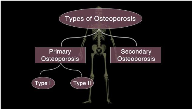 Osteoporosis in Older Adults http://www.