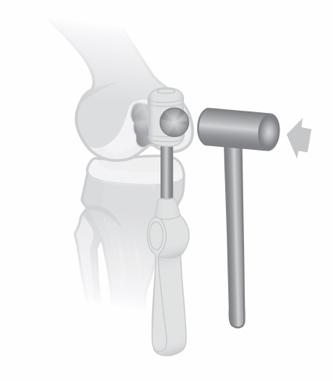 14. Prior to placing the WaveKahuna Femoral Component on the Implant Holder, make sure