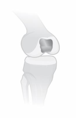 Align the WaveKahuna Femoral Component on the Implant Holder.