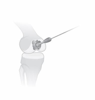 5mm Femoral Guide Pin until secure in the bone (approximately 10mm deep). 2b. Alternatively, the Offset Drill Guide may be used to place the 2.5mm Femoral Guide Pin. Align the L laser mark to the lateral aspect of the femur.