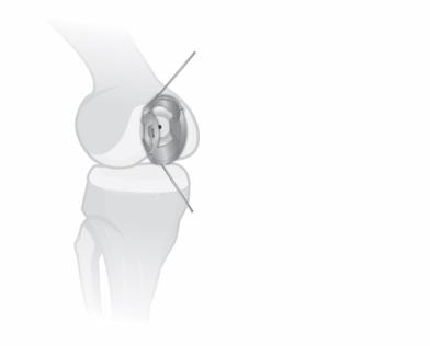 In knees with a dysplastic or flattened trochlea, the Guide Block may not sit flush to the reamed area.