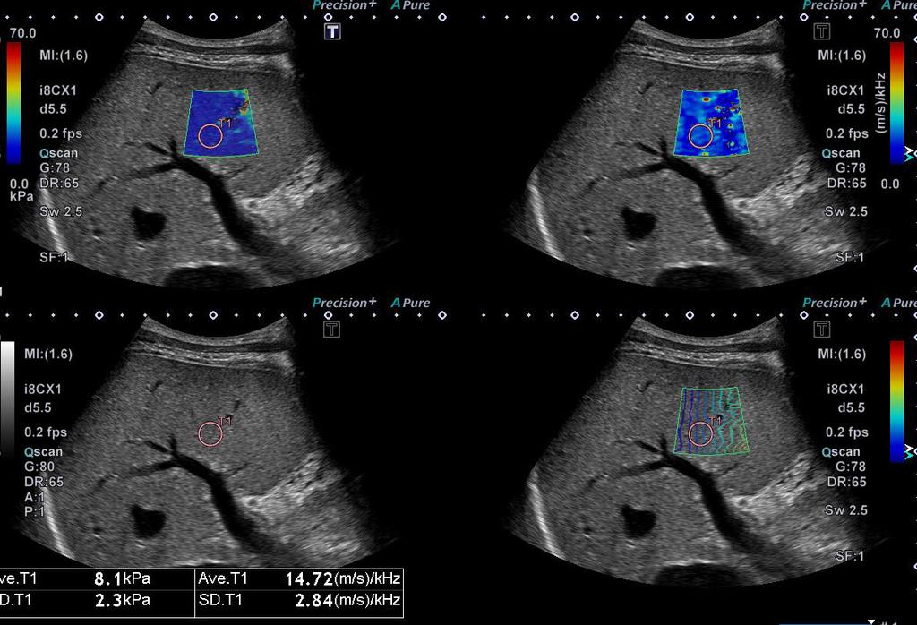 Preliminary clinical experience with Shear Wave Dispersion Imaging for liver viscosity Dr.