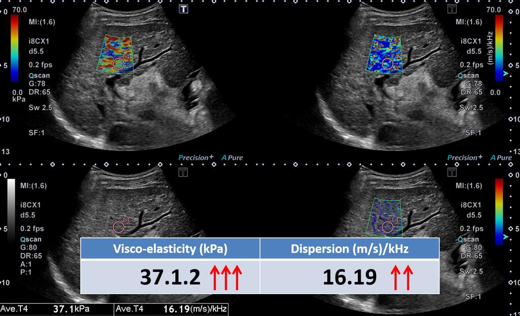 In addition to conventional viscoelasticity imaging with shear wave, SWD is an innovative imaging technique that offers viscosity evaluation with a potential for additional pathophysiological