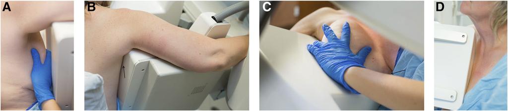 FIGURE 4. Proper breast positioning for MLO view. (A) Detector angle matches angle of pectoral muscle. (B) Patient s arm is on top of detector, with no gap (arrow) between detector and chest.