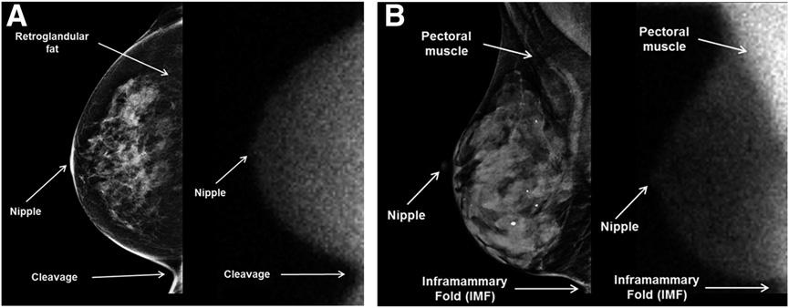 FIGURE 6. Proper breast positioning on mammography (left) and MBI (right).