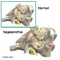 Rationale What do doctors hope to achieve? Foraminotomy alleviates the symptoms of foraminal stenosis. In foraminal stenosis, a nerve root is compressed inside the neural foramen.