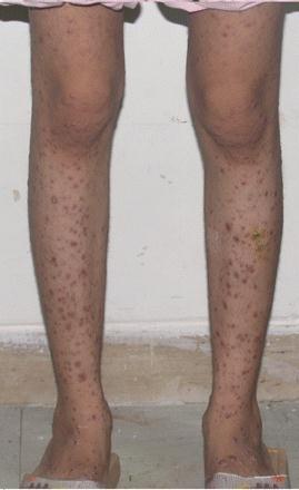 Disseminated Cutaneous Leishmaniasis Characterized by hundreds of lesions Papules, nodules, ulcers, acnelike