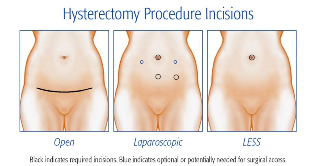 General Consensus: Vaginal Route > Laparoscopic Route > Abdominal Route Even though, there is no