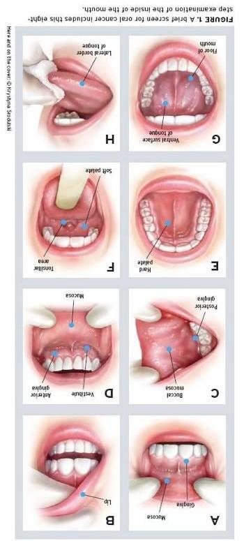 Oral Cancer Examination An oral cancer examination is recommended during every routine visit to the dentist and at any time that certain symptoms are present such as lesions in the mouth that don t