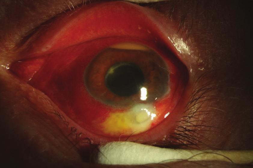 2 International Inflammation (a) (b) Figure 1: Photographs of the left eye of 55-year-old male presenting with BAE from Moraxella. (a) Presenting VA: HM, IOP: 19 mmhg.