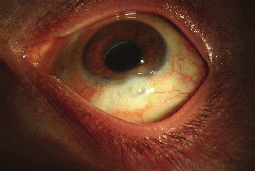 All patients had prior glaucoma filtering surgery. BAE was defined as intraocular infection with vitreous involvement receiving treatment with intravitreal antibiotics.