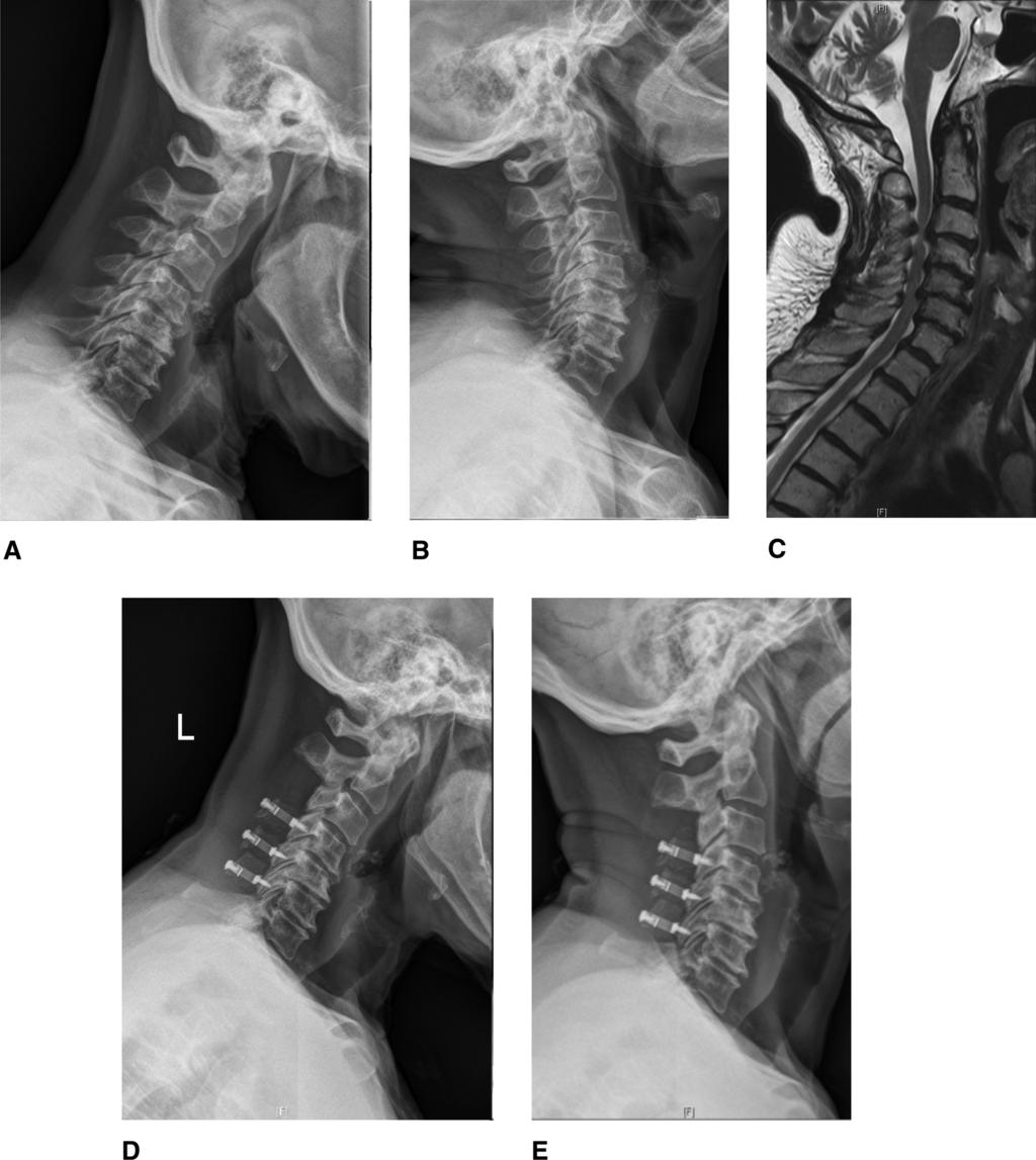 Cervical Laminoplasty: Indications, Surgical Considerations, and Clinical Outcomes for myelopathy to determine the need for surgical management.