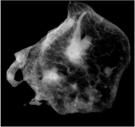 Left upper lobectomy Staging AJCC 8 th Edition Tumor 1 - Lepidic predominant, 0.9 cm invasion or T1a (not MIA) correct 2.0 cm to 1.0 for invasive size 1 3 Tumor 2 - Lepidic predominant, 0.