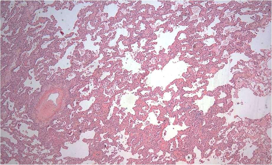 Adenocarcinoma in situ (non-mucinous) - histology Alveolar
