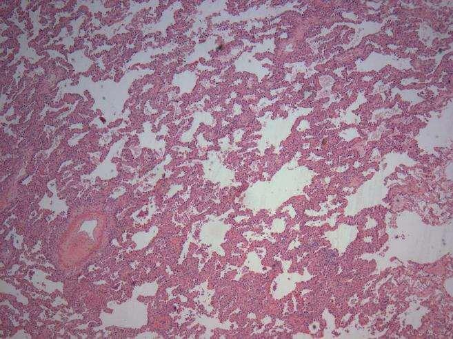 scarring/ central scarring. Alveolar macrophages can be seen.