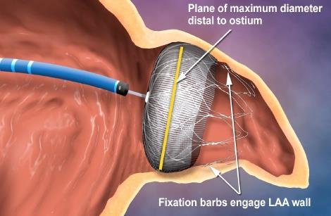 WATCHMAN LAA Closure Device FDA Approval: March 2015 Patient-level