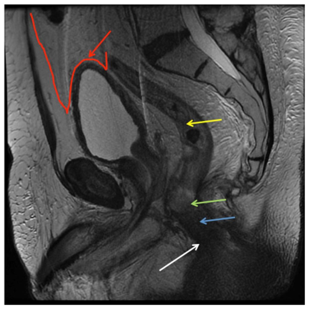 Fig. 4: Red arrow shows the peritoneal reflection over the pelvic organs.