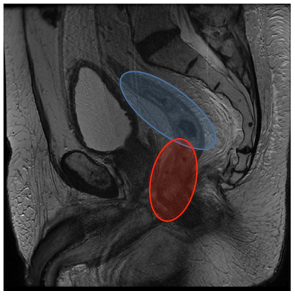 Fig. 5: Cancer in the upper two thirds (Blue) likely to under go lower anterior resection with anastomosis and retain normal continence
