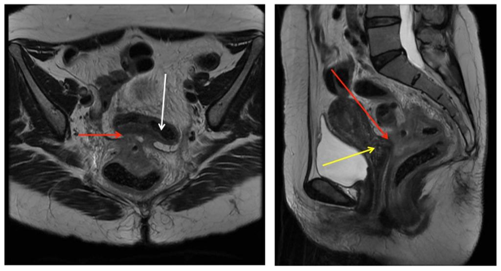 Fig. 6: MRI images show an axial plane perpendicular to the rectal wall and a lateral plane.