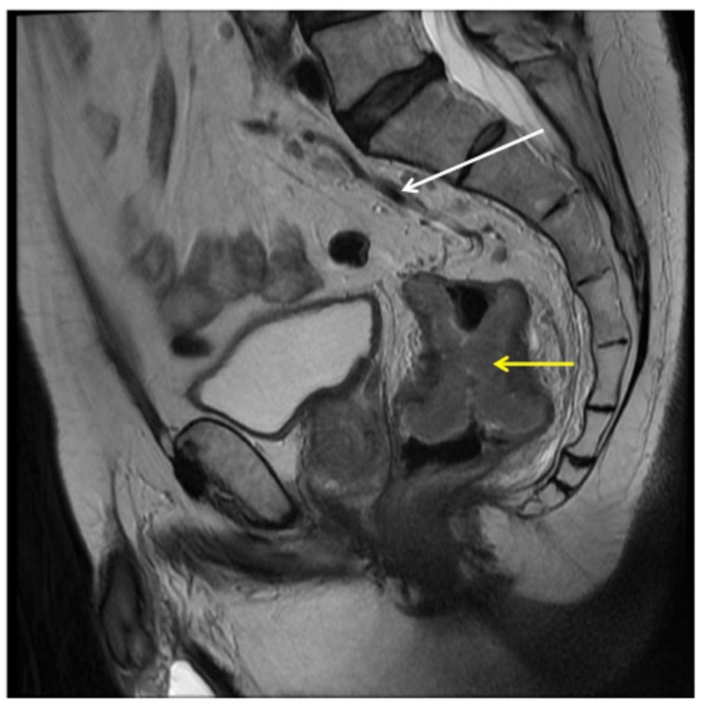 Fig. 7: Sagittal section MRI showing a large rectal tumour