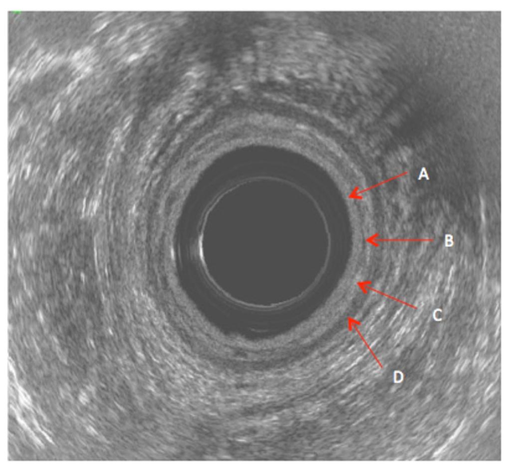 Fig. 8: Normal anorectal ultrasound scan demonstrating the layers of the rectum.