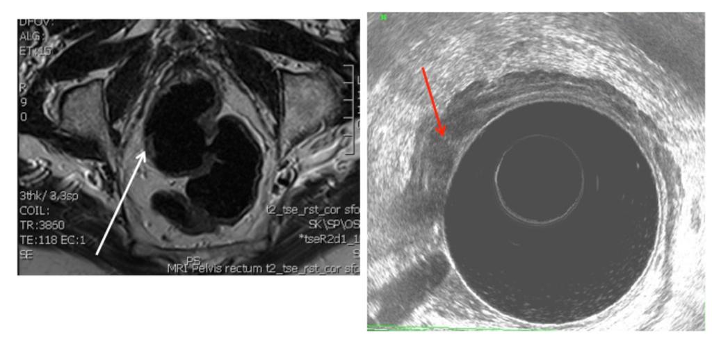Fig. 9: MRI showing a rectal lesion which is staged as T2 or less (white arrow).