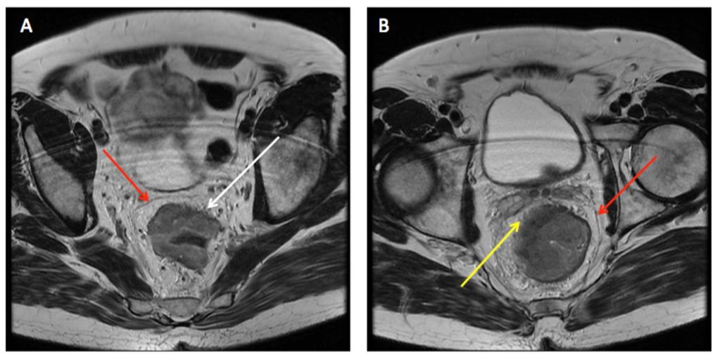 Fig. 11: 2 examples of T3 stage rectal adenocarcinoma. (A) shows a horse shoes shaped tumor with mesorectal fat invasion at the 12-2 o'clock position (white arrow).