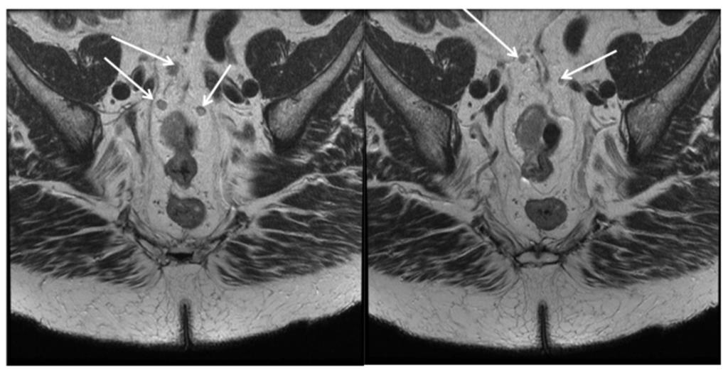 Fig. 13: Shows 2 slices in the coronal plane of the same patient.