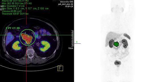SARTATE SARTATE (Cu-64/Cu-67) is a first-in-class, highly targeted theranostic radiopharmaceutical, which can image, perform prospective dosimetry, and subsequently treat cancers that