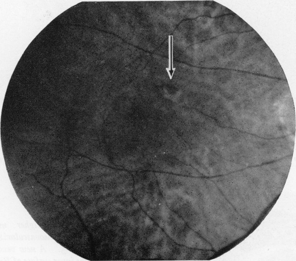 956 S. H. Sarks A similar smaller area of depigmentation was also present in the left eye, immediately below the macula, which showed a coarse pigmentary disturbance. The visual acuity was 3/6.