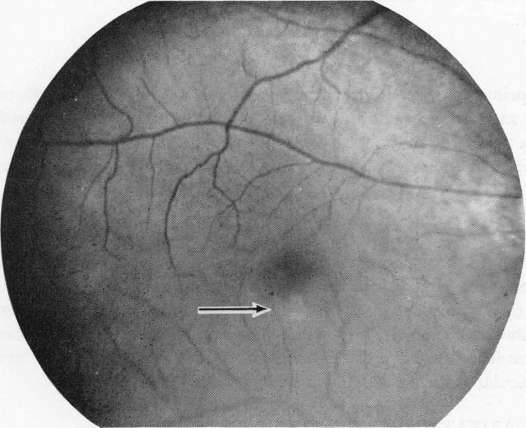 9 Right fundus of 86- year-old Chinese man.