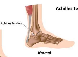 Introduction Spectrum of tendon injury