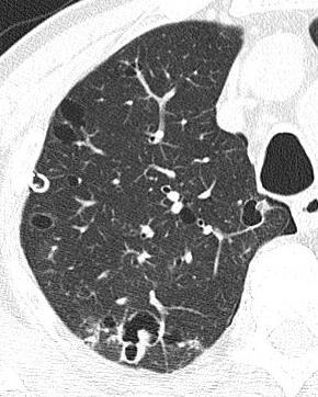 and thrombus onchiole Pulmonary