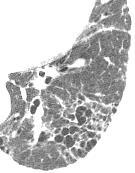 Emphysema & interstitial fibrosis Centrilobular