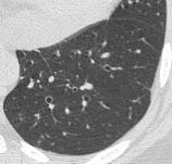 Pulmonary oligemia Oligemia Geographic area of low density, larger than lobule Small PA in low density area, collateral vessel Normal to
