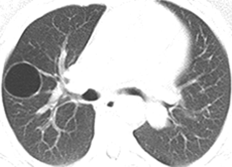 Light-Chain Deposition Disease Lung involvement: rare. CT: Cysts: o believed to correspond to dilation of the small airways.