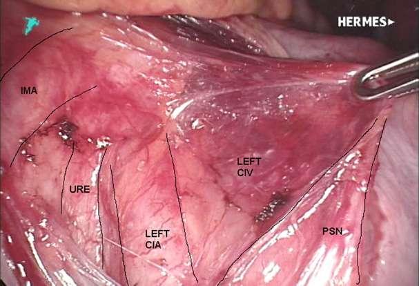 Relationship of inferior mesenteric artery and surrounding structures with retraction of peritoneal edge.
