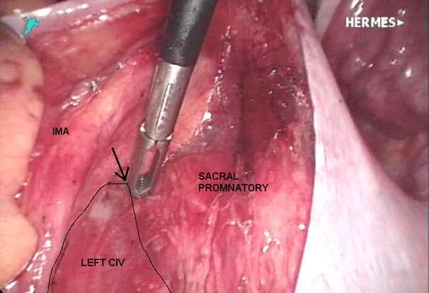 Entry into avascular space (arrow) between inferior mesenteric artery and left common