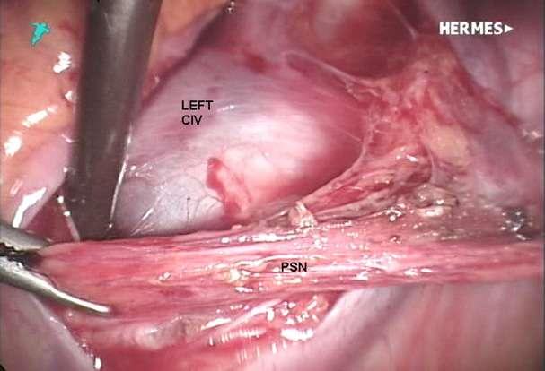 Presacral nerve reflected cephalad to expose the left common iliac vein.