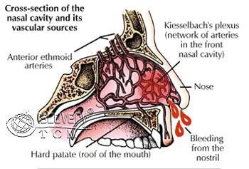 The bleeding may be arterial or venous, and most episodes
